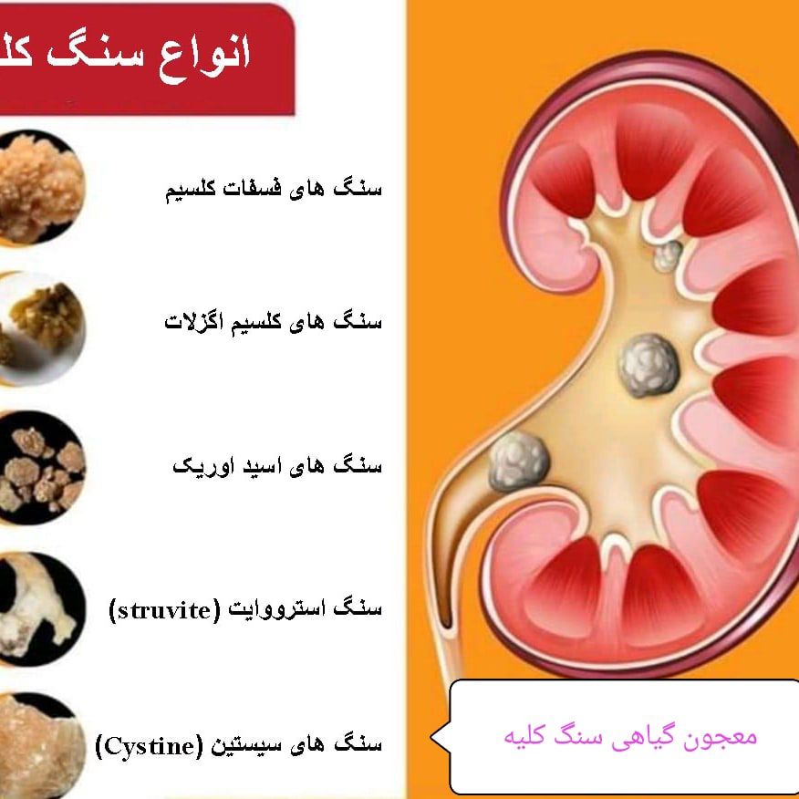 داروی گیاهی سنگ کلیه
