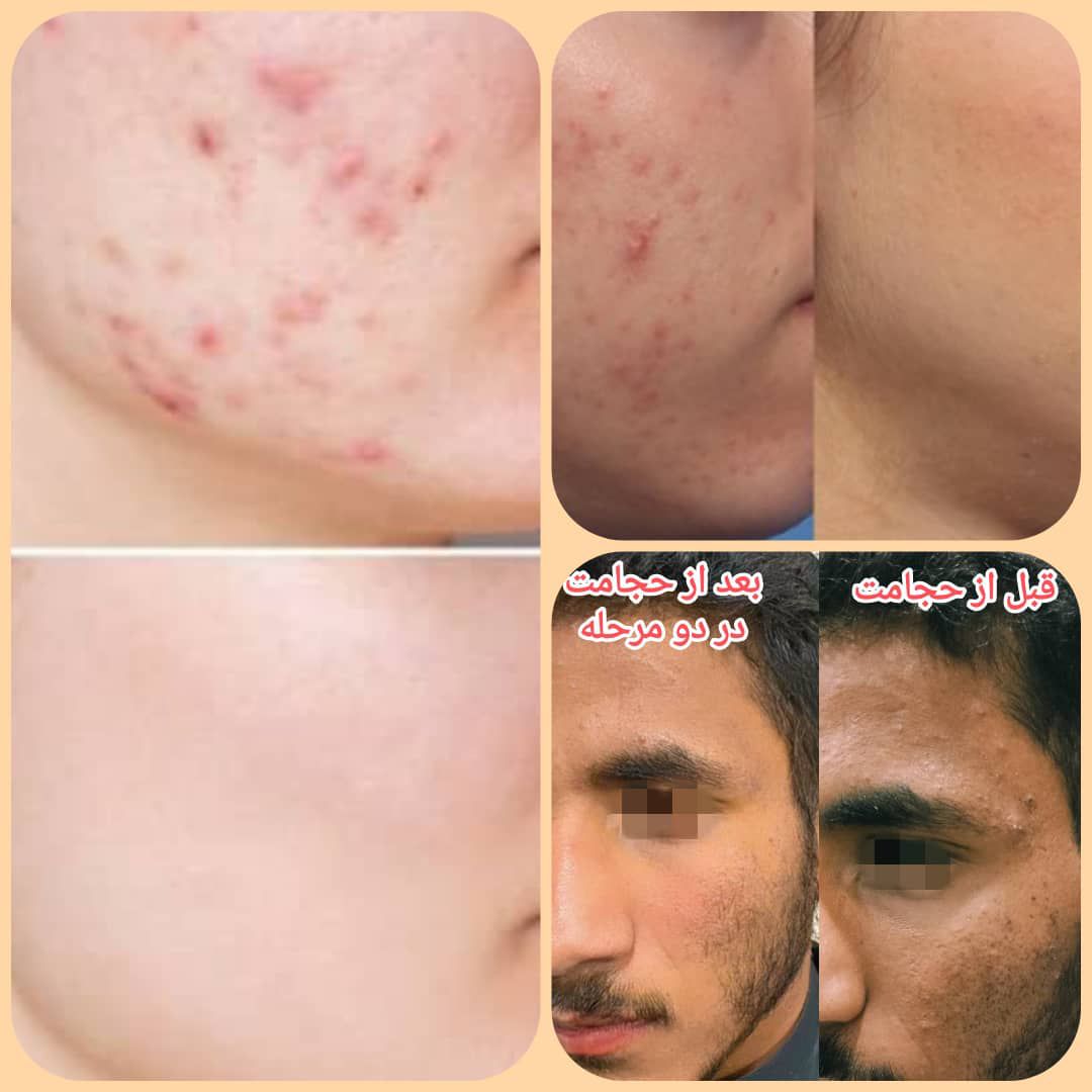 حجامت رفع جوش صورت و بدن 