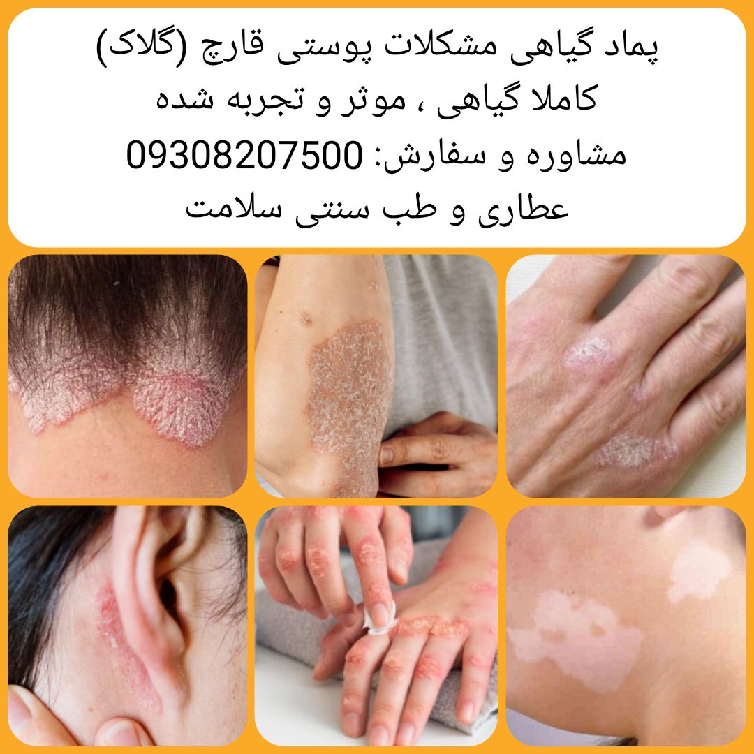 پماد گیاهی مشکلات پوستی قارچی ( گلاک )
