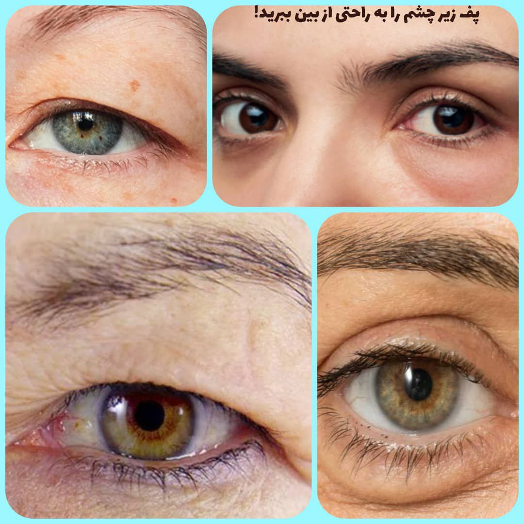 قطره گیاهی افتادگی پلک و پف زیر چشم 